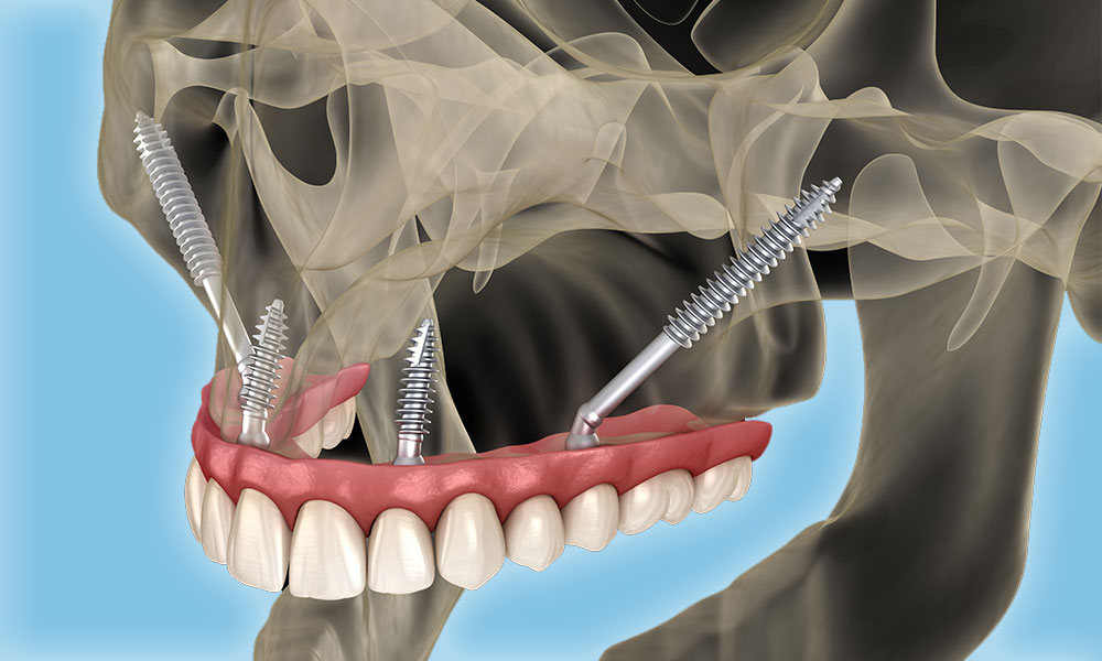 The Pros and Cons of Zygomatic Implants